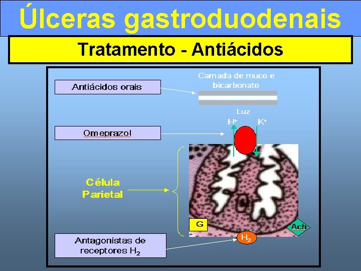 Úlceras gastroduodenais Tratamento - Antiácidos 