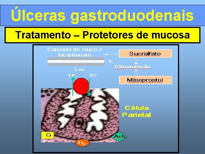 Úlceras gastroduodenais Tratamento – Protetores de mucosa 