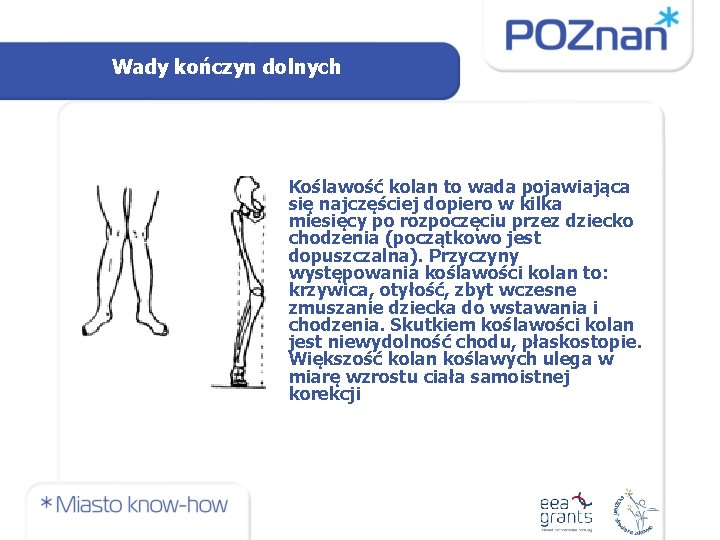 Wady kończyn dolnych Koślawość kolan to wada pojawiająca się najczęściej dopiero w kilka miesięcy