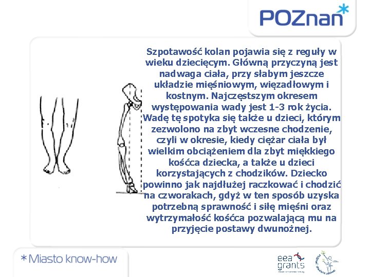 Szpotawość kolan pojawia się z reguły w wieku dziecięcym. Główną przyczyną jest nadwaga ciała,