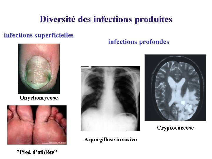 Diversité des infections produites infections superficielles infections profondes Onychomycose Cryptococcose Aspergillose invasive "Pied d'athlète"