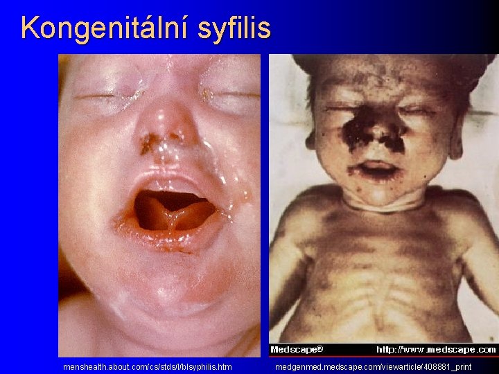 Kongenitální syfilis menshealth. about. com/cs/stds/l/blsyphilis. htm medgenmed. medscape. com/viewarticle/408881_print 