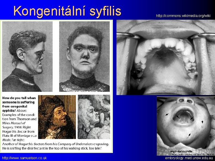 Kongenitální syfilis http: //www. samuelson. co. uk http: //commons. wikimedia. org/wiki embryology. med. unsw.