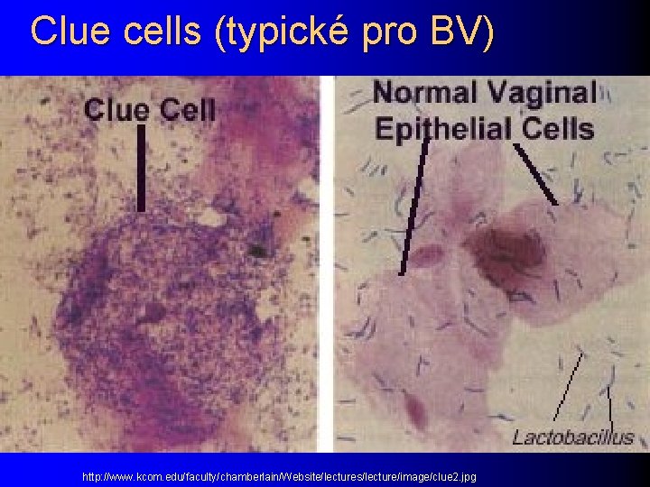 Clue cells (typické pro BV) http: //www. kcom. edu/faculty/chamberlain/Website/lectures/lecture/image/clue 2. jpg 