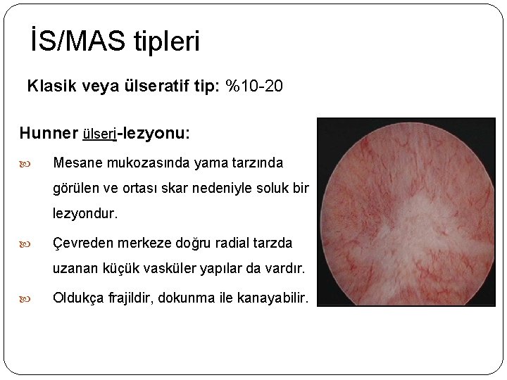 İS/MAS tipleri Klasik veya ülseratif tip: %10 -20 Hunner ülseri-lezyonu: Mesane mukozasında yama tarzında