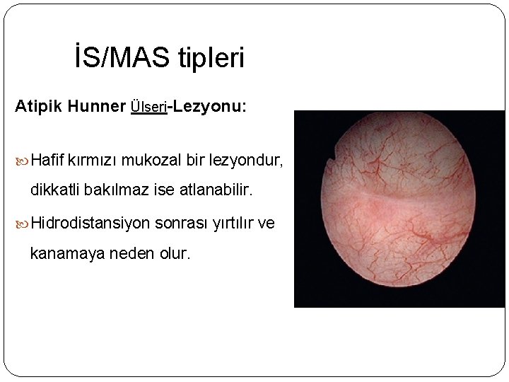 İS/MAS tipleri Atipik Hunner Ülseri-Lezyonu: Hafif kırmızı mukozal bir lezyondur, dikkatli bakılmaz ise atlanabilir.