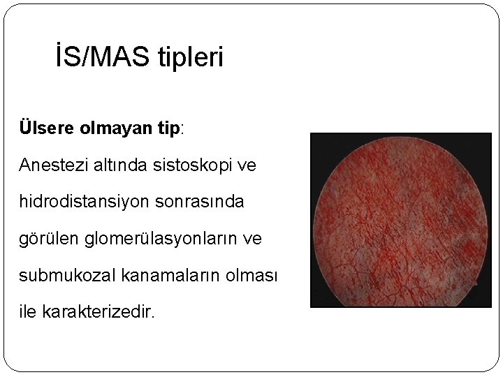 İS/MAS tipleri Ülsere olmayan tip: Anestezi altında sistoskopi ve hidrodistansiyon sonrasında görülen glomerülasyonların ve