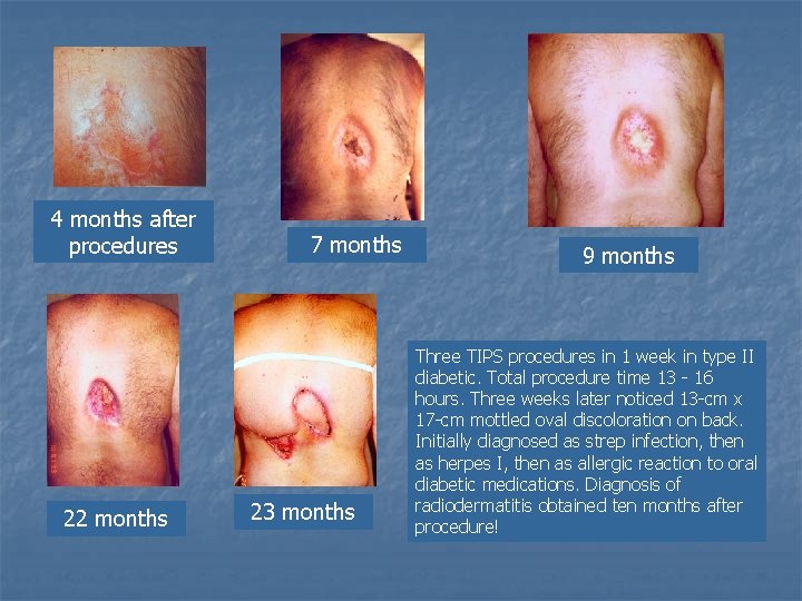 4 months after procedures 22 months 7 months 23 months 9 months Three TIPS