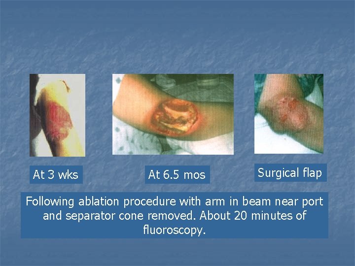 At 3 wks At 6. 5 mos Surgical flap Following ablation procedure with arm