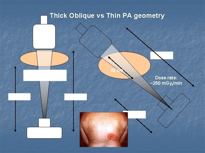 Thick Oblique vs Thin PA geometry 100 cm 40 cm Dose rate: 20 –