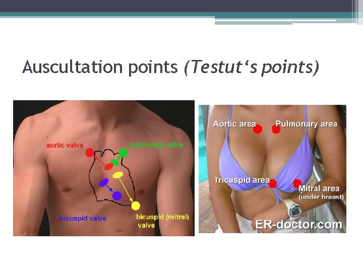 Auscultation points (Testut‘s points) 