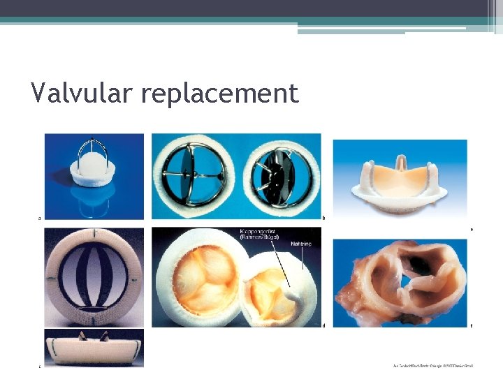 Valvular replacement 