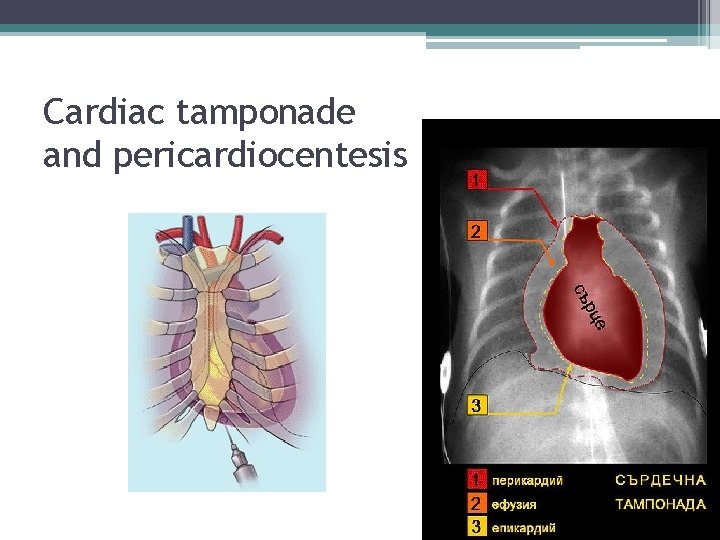 Cardiac tamponade and pericardiocentesis 