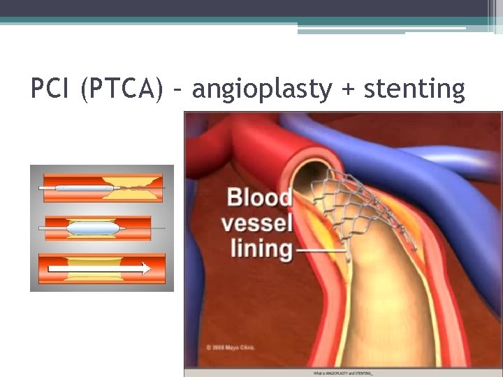 PCI (PTCA) – angioplasty + stenting 