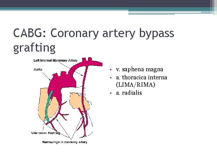 CABG: Coronary artery bypass grafting • v. saphena magna • a. thoracica interna (LIMA/RIMA)