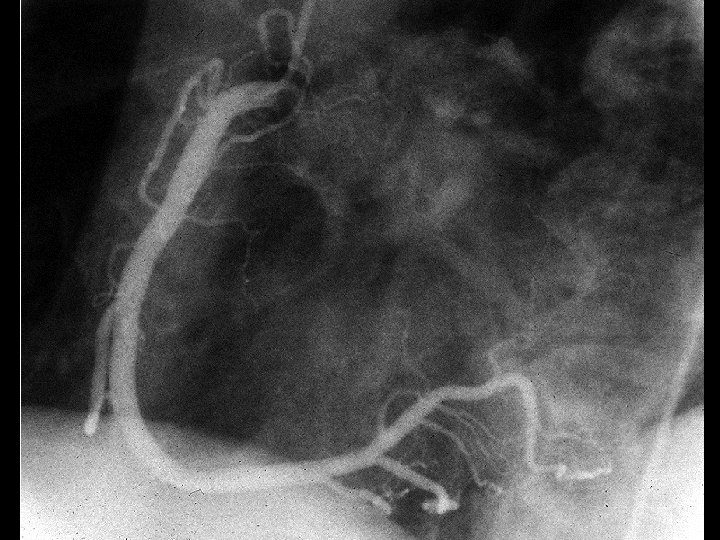 Coronary cathetrisation coronarography 