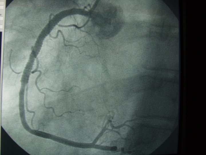 Coronarography– RCA – stent implantation 