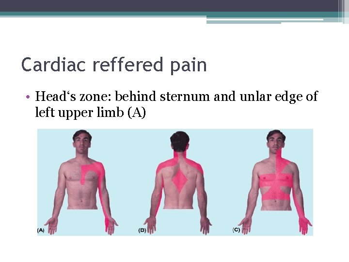 Cardiac reffered pain • Head‘s zone: behind sternum and unlar edge of left upper