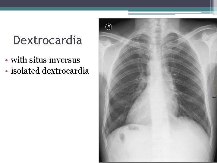 Dextrocardia • with situs inversus • isolated dextrocardia 