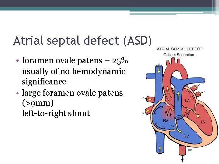 Atrial septal defect (ASD) • foramen ovale patens – 25% usually of no hemodynamic