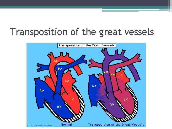 Transposition of the great vessels 