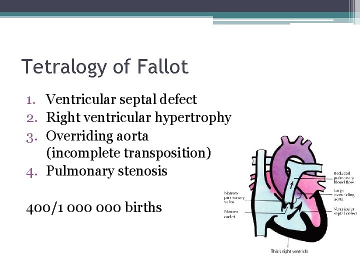 Tetralogy of Fallot 1. Ventricular septal defect 2. Right ventricular hypertrophy 3. Overriding aorta
