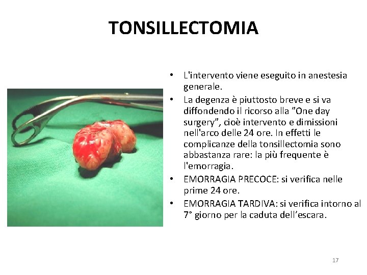 TONSILLECTOMIA • L'intervento viene eseguito in anestesia generale. • La degenza è piuttosto breve TONSILLECTOMIA • L'intervento viene eseguito in anestesia generale. • La degenza è piuttosto breve