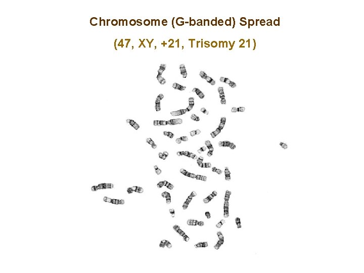 Chromosome (G-banded) Spread (47, XY, +21, Trisomy 21) 