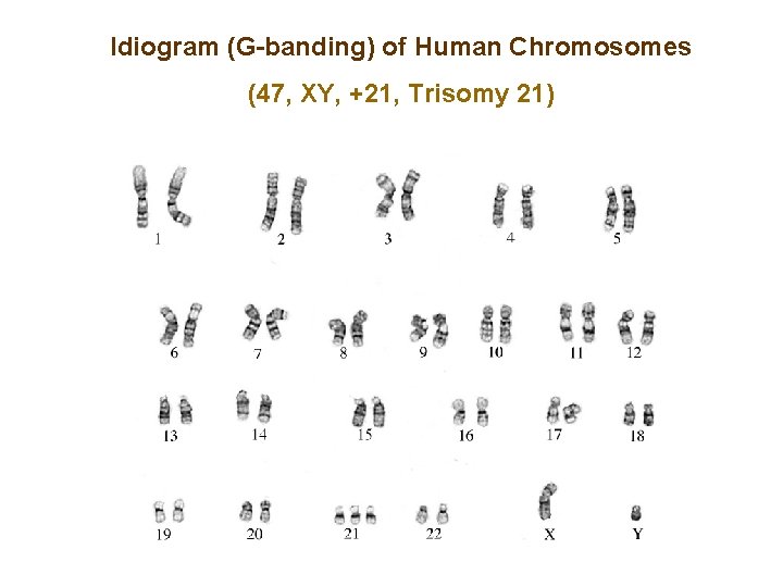 Idiogram (G-banding) of Human Chromosomes (47, XY, +21, Trisomy 21) 