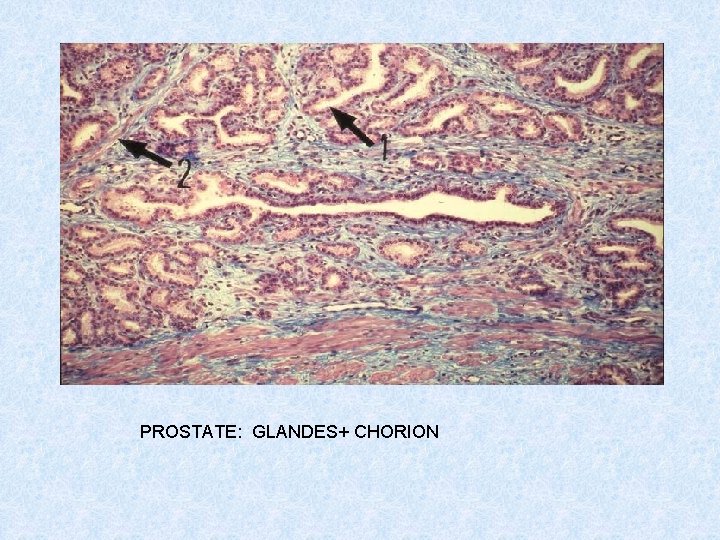 PROSTATE: GLANDES+ CHORION 