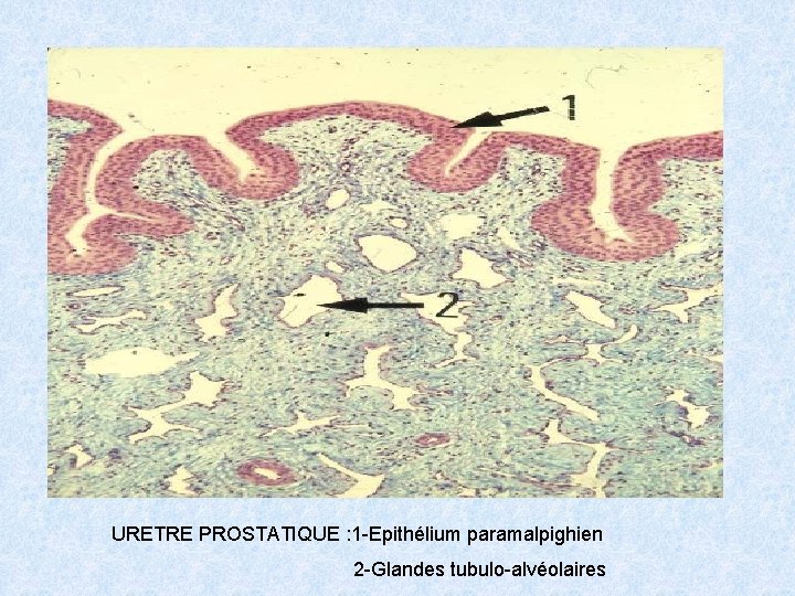 URETRE PROSTATIQUE : 1 -Epithélium paramalpighien 2 -Glandes tubulo-alvéolaires 