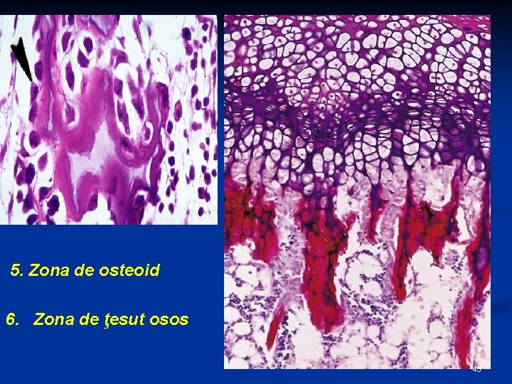5. Zona de osteoid 6. Zona de ţesut osos 45 