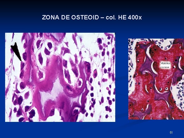ZONA DE OSTEOID – col. HE 400 x 51 