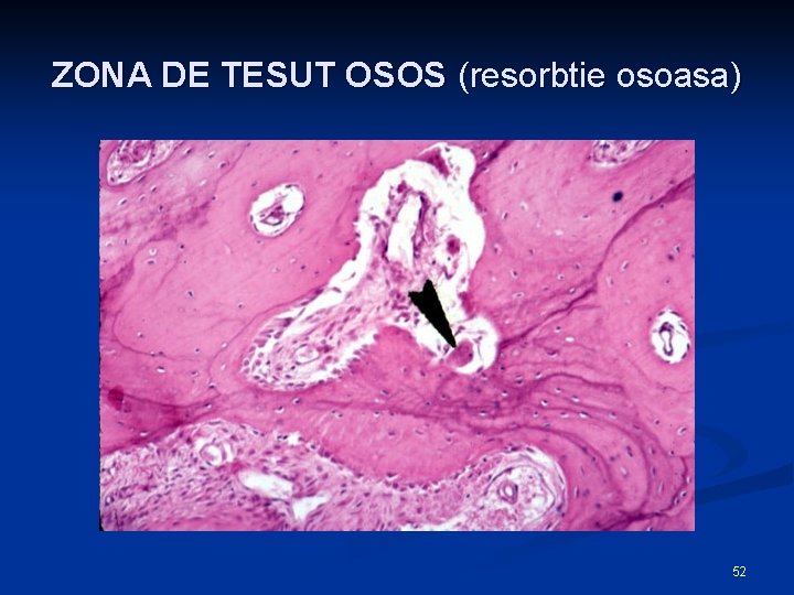 ZONA DE TESUT OSOS (resorbtie osoasa) 52 