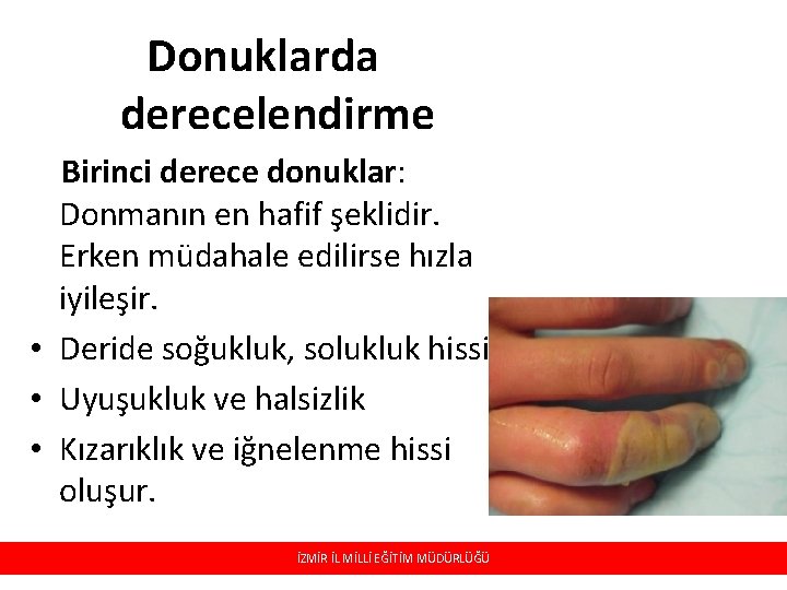 Donuklarda derecelendirme Birinci derece donuklar: Donmanın en hafif şeklidir. Erken müdahale edilirse hızla iyileşir. Donuklarda derecelendirme Birinci derece donuklar: Donmanın en hafif şeklidir. Erken müdahale edilirse hızla iyileşir.