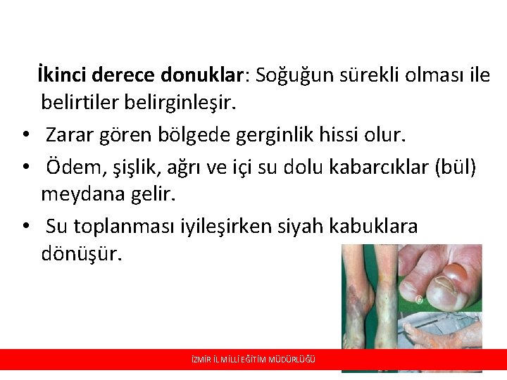 İkinci derece donuklar: Soğuğun sürekli olması ile belirtiler belirginleşir. • Zarar gören bölgede gerginlik İkinci derece donuklar: Soğuğun sürekli olması ile belirtiler belirginleşir. • Zarar gören bölgede gerginlik