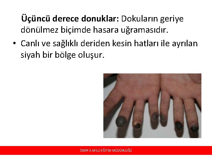 Üçüncü derece donuklar: Dokuların geriye dönülmez biçimde hasara uğramasıdır. • Canlı ve sağlıklı deriden Üçüncü derece donuklar: Dokuların geriye dönülmez biçimde hasara uğramasıdır. • Canlı ve sağlıklı deriden