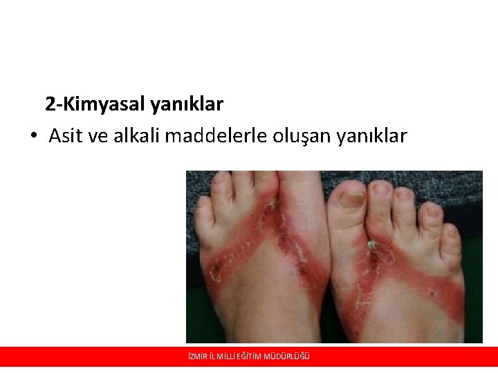 2 -Kimyasal yanıklar • Asit ve alkali maddelerle oluşan yanıklar İZMİR İL MİLLİ EĞİTİM 2 -Kimyasal yanıklar • Asit ve alkali maddelerle oluşan yanıklar İZMİR İL MİLLİ EĞİTİM