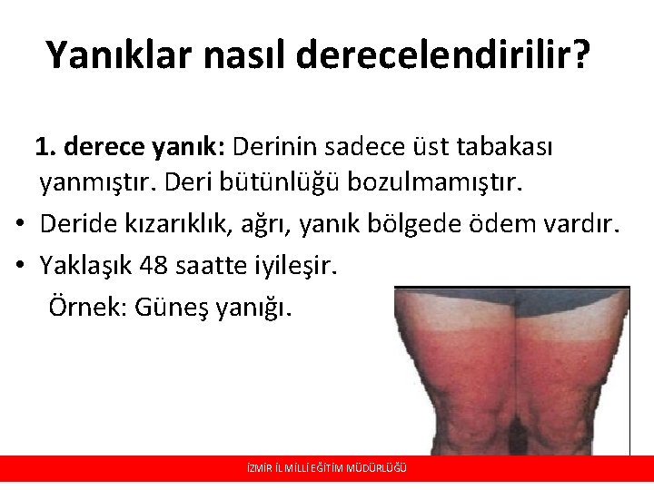 Yanıklar nasıl derecelendirilir? 1. derece yanık: Derinin sadece üst tabakası yanmıştır. Deri bütünlüğü bozulmamıştır. Yanıklar nasıl derecelendirilir? 1. derece yanık: Derinin sadece üst tabakası yanmıştır. Deri bütünlüğü bozulmamıştır.