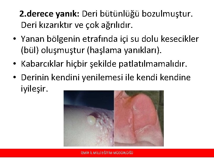 2. derece yanık: Deri bütünlüğü bozulmuştur. Deri kızarıktır ve çok ağrılıdır. • Yanan bölgenin 2. derece yanık: Deri bütünlüğü bozulmuştur. Deri kızarıktır ve çok ağrılıdır. • Yanan bölgenin