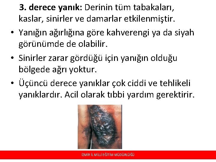 3. derece yanık: Derinin tüm tabakaları, kaslar, sinirler ve damarlar etkilenmiştir. • Yanığın ağırlığına 3. derece yanık: Derinin tüm tabakaları, kaslar, sinirler ve damarlar etkilenmiştir. • Yanığın ağırlığına