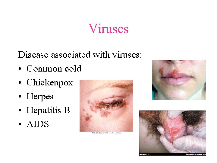 Viruses Disease associated with viruses: • Common cold • Chickenpox • Herpes • Hepatitis