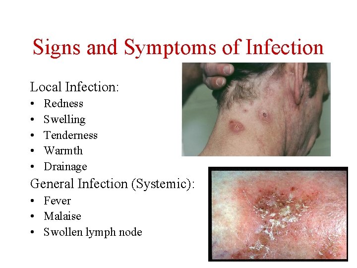 Signs and Symptoms of Infection Local Infection: • • • Redness Swelling Tenderness Warmth