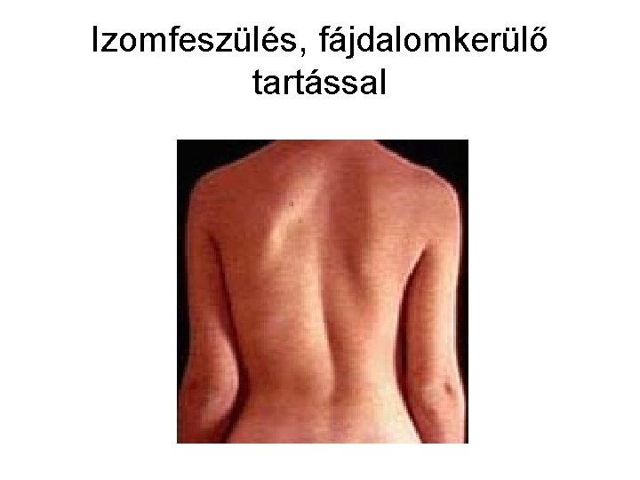 Izomfeszülés, fájdalomkerülő tartással 