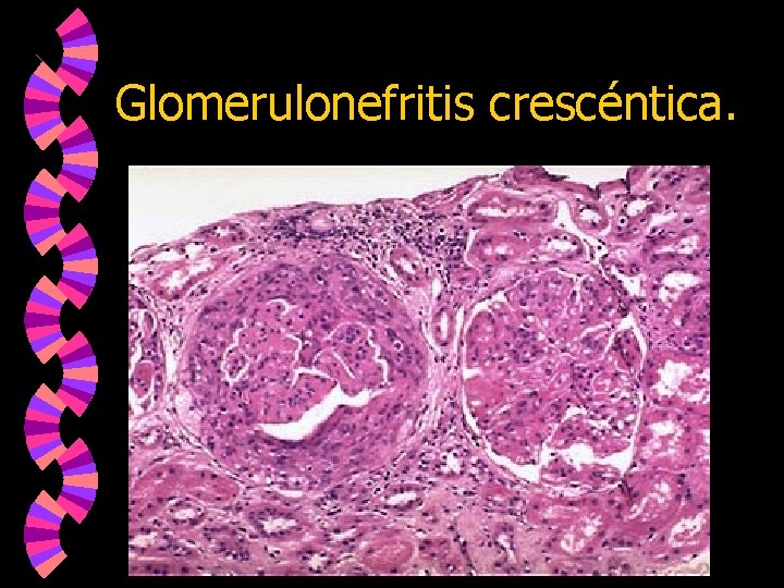 Glomerulonefritis crescéntica. 