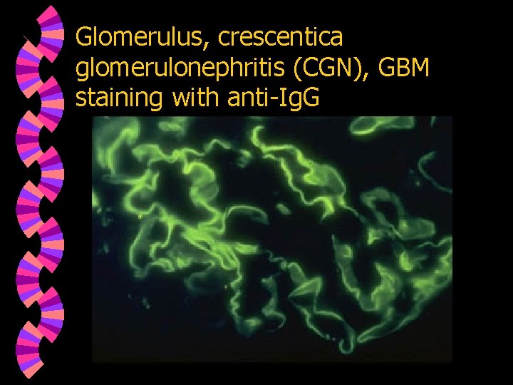 Glomerulus, crescentica glomerulonephritis (CGN), GBM staining with anti-Ig. G 