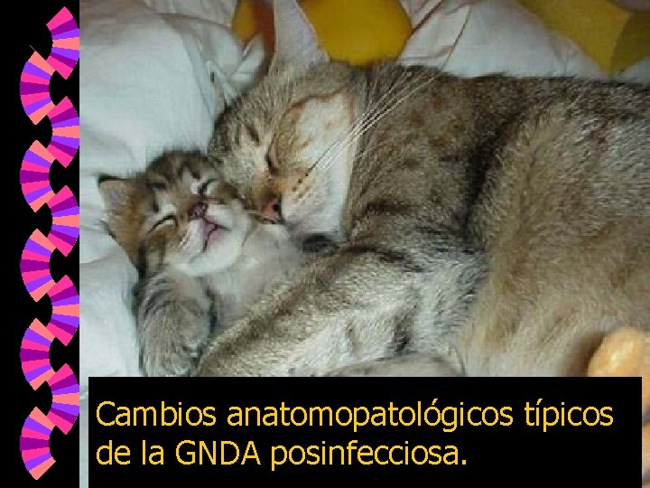 Cambios anatomopatológicos típicos de la GNDA posinfecciosa. 