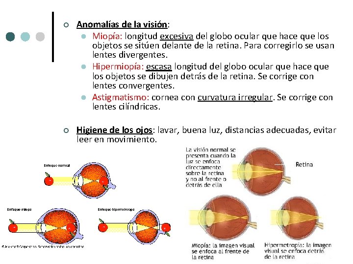 ¢ Anomalías de la visión: l Miopía: longitud excesiva del globo ocular que hace ¢ Anomalías de la visión: l Miopía: longitud excesiva del globo ocular que hace