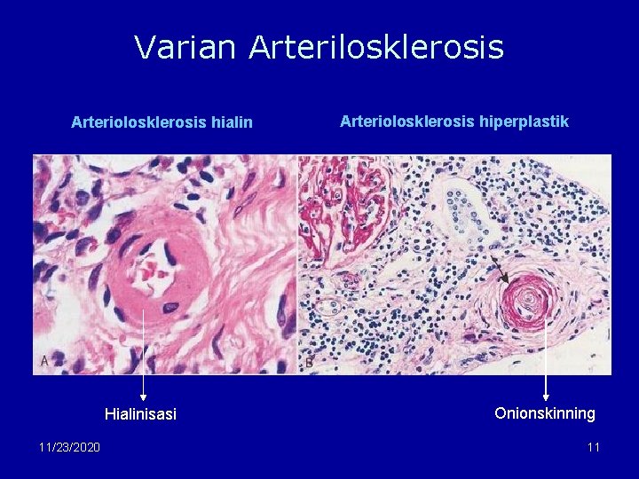 Varian Arterilosklerosis Arteriolosklerosis hialin Hialinisasi 11/23/2020 Arteriolosklerosis hiperplastik Onionskinning 11 