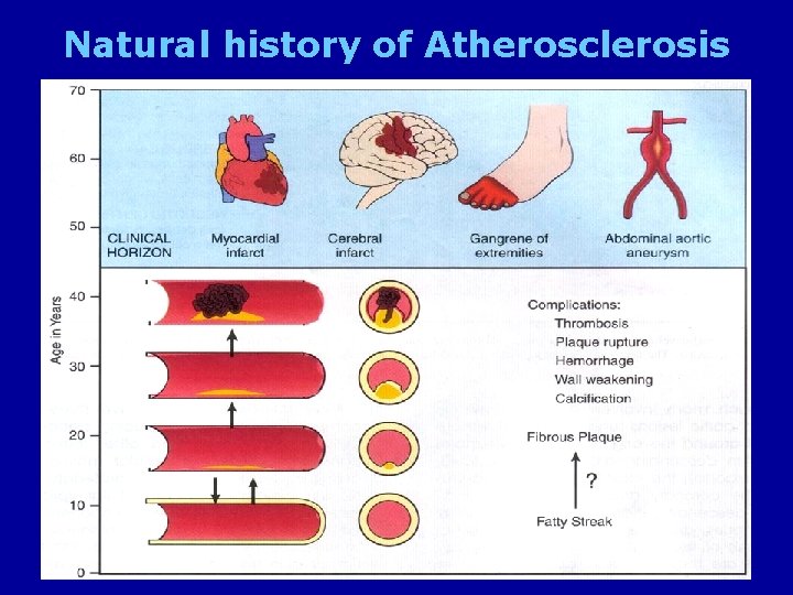 Natural history of Atherosclerosis 11/23/2020 13 